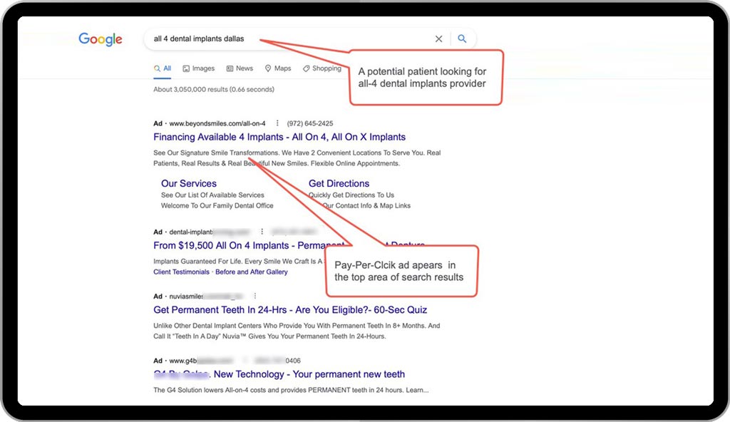 Example 3 for dental advertising - Google PPC advertising: A potential patient is searching for dental implants in Dallas TX Example 3 for dental advertising - Google PPC advertising: A potential patient is searching for dental implants in Dallas TX