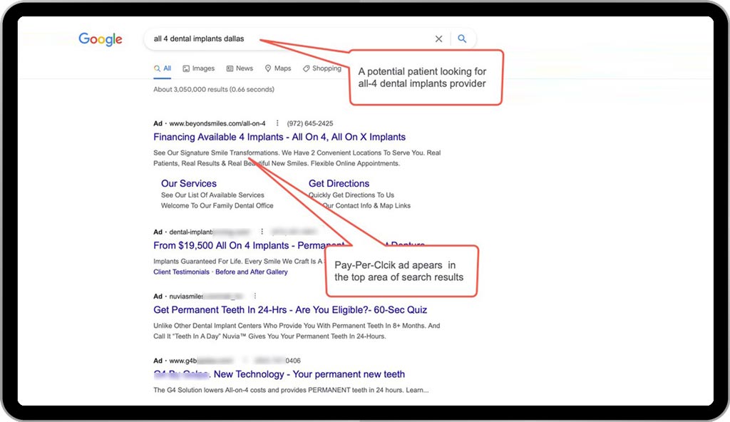 Example 3 for dental advertising - Google PPC advertising: A potential patient is searching for dental implants in Dallas TX